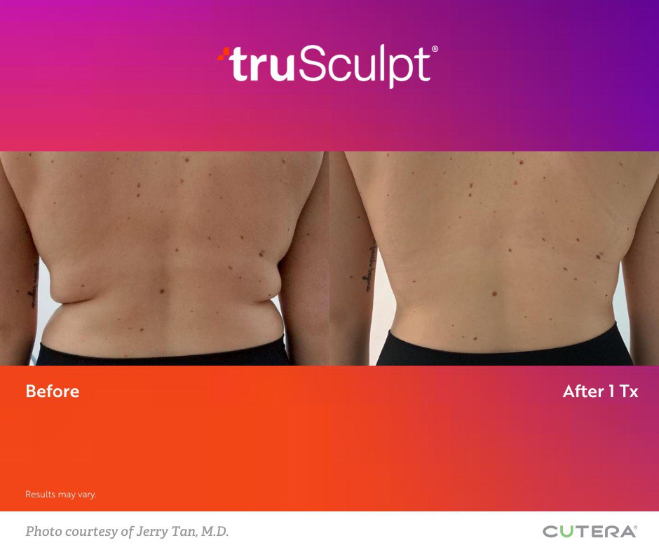 truSculpt® von Cutera – Alles, was Sie wissen müssen