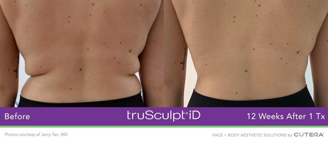 truSculpt® von Cutera – Alles, was Sie wissen müssen