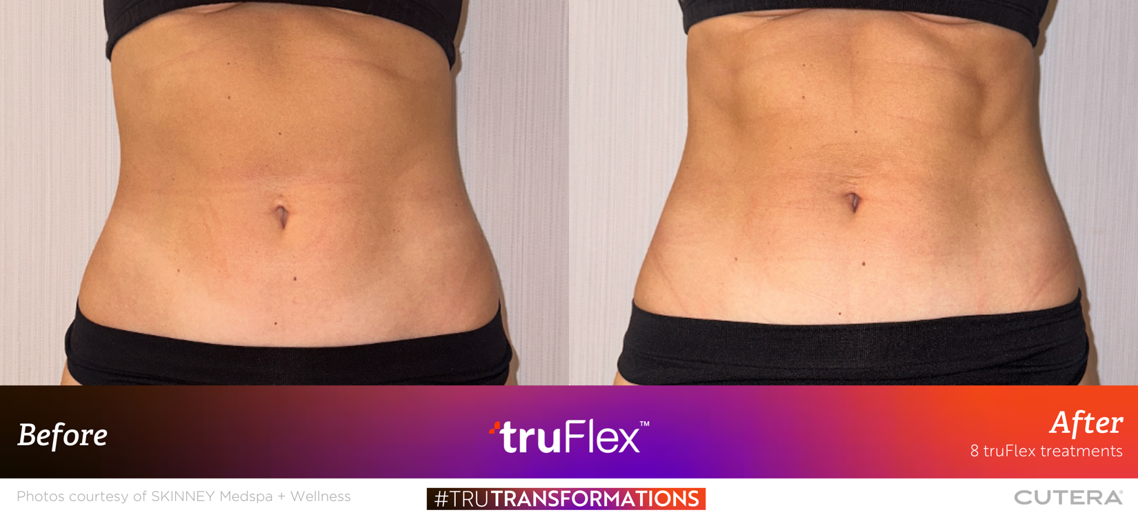 truFlex B&A-truTransformation-Skinney